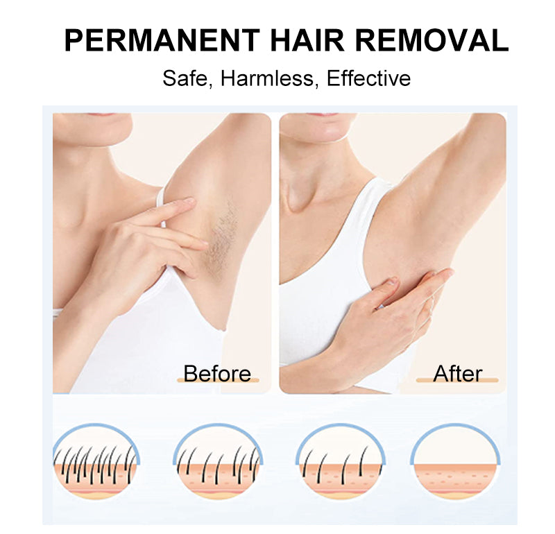 Aolemon Multi Mode IPL Laser Hair Remover - At-Home Permanent Hair Reduction
