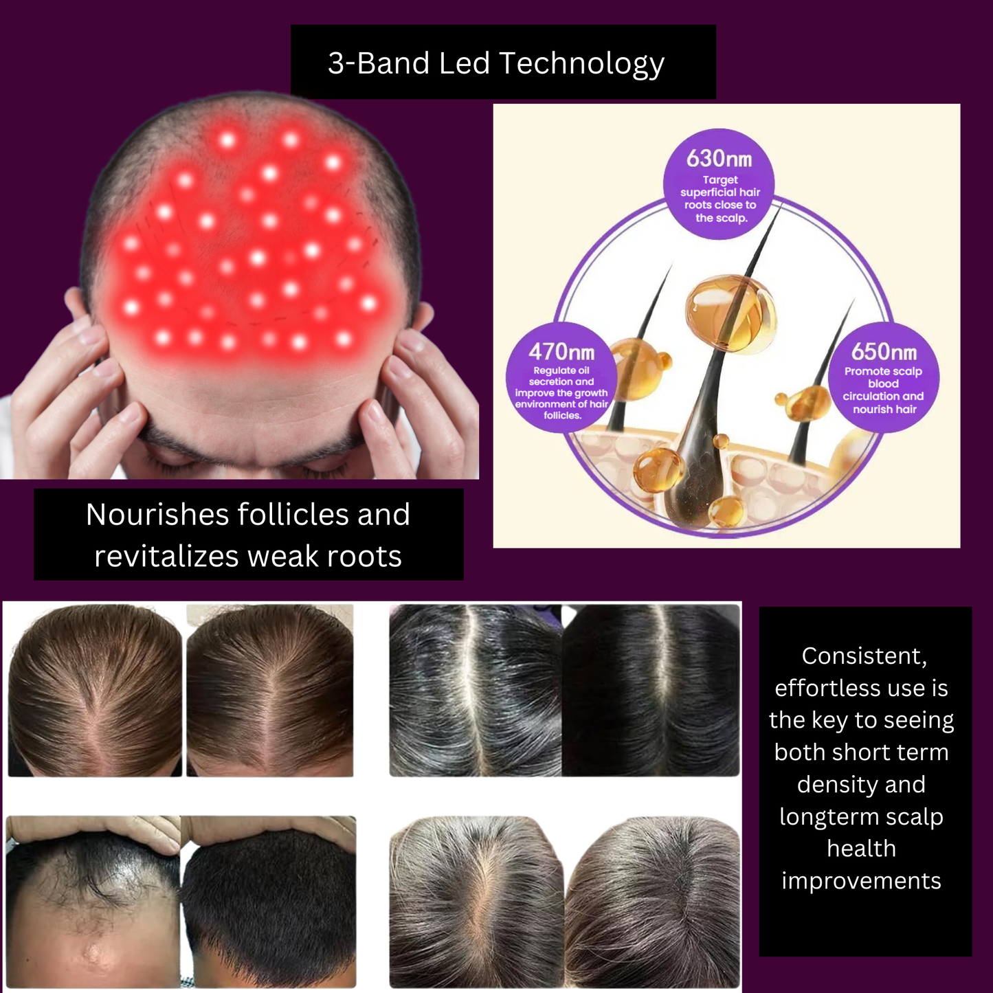DermaRegen Laser LED Hair Growth Cap